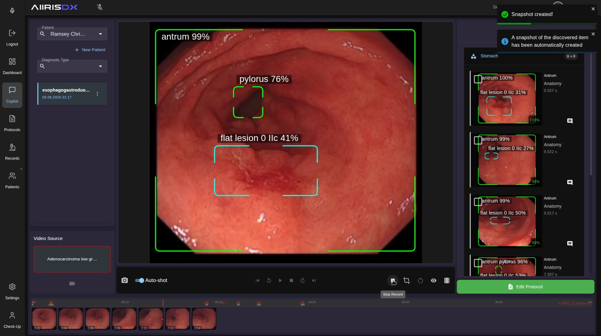 AiirisDX examination interface showing a live endoscopy feed with highlighted findings and review controls.